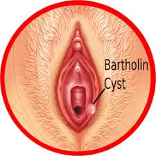 I had bartholin cyst 3 years ago and i was in agony and walking was so painful. 11 Fast Home Remedies For Bartholin Cysts