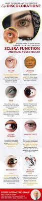 Got Eye Discoloration No Problem Call 310 820 2020 Dr Paul Super Dry Eyes Optometric Angel