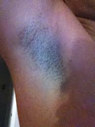 The place is clean and the ladies there are friendly. Ideal Image Laser Hair Removal Miami Fl Review Realself