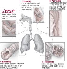 How do you use throat wash in a sentence? The Respiratory Tract And Its Infections Harvard Health Pharyngitis Respiratory Chronic Pharyngitis