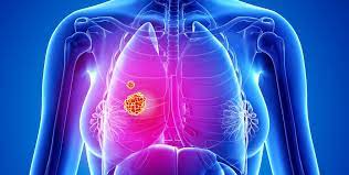 If symptoms do occur in the early stages. 9 Signs And Symptoms Of Lung Cancer According To Doctors