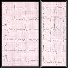 Image result for Extrasystole