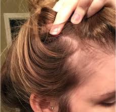Minoxidil is recommended for women with however, it's worth noting that some of these women had unwanted facial hair before using minoxidil (and were. What Happens When You Use Rogaine Or Minoxidil Once A Day