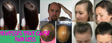 After two or three monthly cycles, katz said hair will grow back 25 or 30 percent faster than usual. Hair Loss Reasons Hair Loss Reasons Hair Loss Treatment Problem Hair Loss