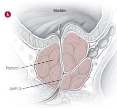 Once a prostate cancer diagnosis has been made, we have some information from the biopsy that gives by using the telephone number provided by top doctors, you automatically agree to let us use your phone number for statistical and commercial purposes. Your Benign Prostatic Hyperplasia Medication When To Consider A Change Harvard Health