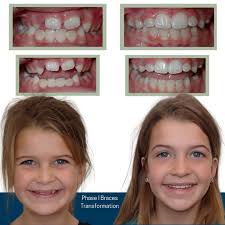Transformation Thursday! Miss Cora had a beautiful Phase I smile  transformation!🤩✨ We recommend see patients for Phase I starting at 7  years old! Questions or ready to schedule? Call us at 864.686.6202 📞