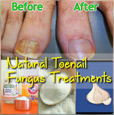 Best Home Remedies To Get Rid Of Toenail Fungus Fast Nail Fungus Remedy Nail Fungus Nail Fungus Cure