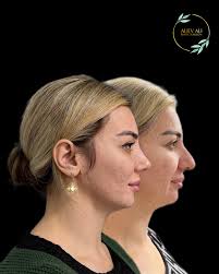 РИНОСЕПТОПЛАСТИКА. Результат через 24 дня. В предыдущей публикации (reels),  была реакция на новый нос на снятии гипса. Тогда был 10-й день после  операции. Путь к вашей мечте лежит через мои знания и