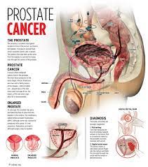 Symptoms of advanced prostate cancer. My Nutrition My Diet Nutritional Partnership With Neolife International Prostate Cancer Symptoms Causes And Treatments