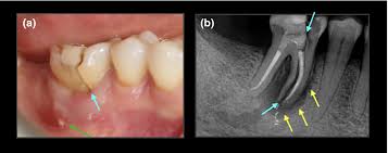 Present status and future directions: vertical root fractures in root  filled teeth - Patel - 2022 - International Endodontic Journal - Wiley  Online Library