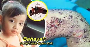 Cara menghilang bekas gigitan tomcat. Bahaya Semut Charlie Makan Kulit