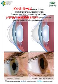 Yara dokusunun oluşması ya da ödem nedeniyle bulanıklaşır. Cicendo Eye Hospital