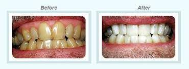 The dentist or dental assistant then applies the zoom hydrogen peroxide whitening gel, which works together with the zoom light to penetrate the teeth and break up the stains and discoloration. Why Zoom Teeth Whitening Healthy Smiles Dental Group