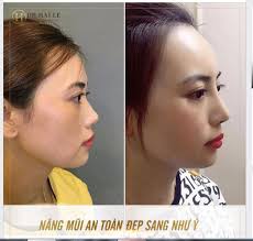 KẾT QUẢ NGAY SAU 40 PHÚT NÂNG MŨI