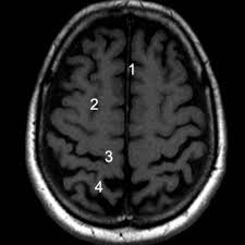 The Anatomy Of The Brain S Lobes With Mri Eurorad