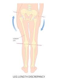 Image result for Functional Leg Length Discrepancy