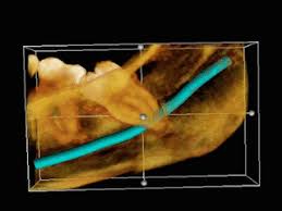 For some of these patients, surgery or orthodontics may be able to remedy the problem. Impacted Wisdom Teeth Wikipedia