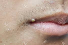 Les boutons cachés ou sous la peau, généralement apparaissent derrière l'oreille, au dessus du nez, le cou, et parfois sur d'autres parties du corps. Gros Bouton A La Bouche Acne Au Visage Banque D Images Et Photos Libres De Droits Image 72241966