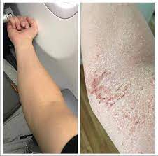 8 Products For Healing Eczema After Quitting Steroid Creams Tsw Josh Wright Piano