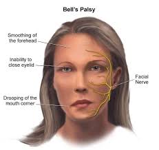 Although the exact reason bell's palsy occurs isn't clear, it's often related to having a viral infection. Case Study Bell S Palsy Thenutritionhealer