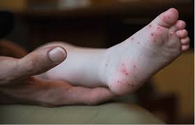 Image result for Hand foot and mouth disease HFMD roof of mouth