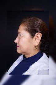 ✨Rinoseptoplastia Ultrasónica de Rápida Recuperación✨Para acceder a una  cita presencial o virtual:✅📲 Citas al Whatsapp: 998 471 613:  https://bit.ly/36flGiU👩‍⚕Dra. Karen Valverde