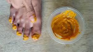 Domnul miluno vine ocazional in romania, sper sa il gasiti. Cum Am Scapat De Ciuperca Unghiilor Fungonis Gel In Romania