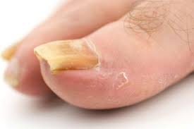 Beat toenail fungus with colloidal silver buy the best nano colloidal silver here! How To Do An Apple Cider Vinegar Foot Soak