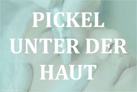 Anders als offen liegende pickel, handelt es sich bei einem pickel unter der haut oft um eine verkapselte entzündung, die zwar eitert, dieser eiter aber nicht bis zur oberen hautschicht durchdringt. Pickel Unter Der Haut Wie Lange Bleiben Die Bestehen