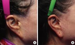 As a point of reference, an otoplasty, which is the surgical procedure to correct external ear deformities, has an average of $4,200 with the cost ranging between $650 and $7500 and considering all locations worldwide according to realself.com. Archives Of Plastic Surgery