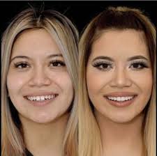 What Does A Smile Makeover Cost?