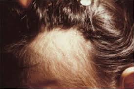 During the telogen phase, which lasts. Hair Loss Who Gets And Causes