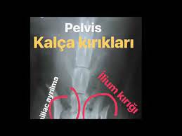 kedi kalca kirigi kendiliginden iyilesir mi