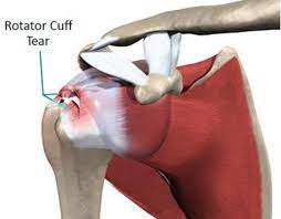 The basic formula insurance companies use to calculate auto accident settlements is: Average Settlement Amounts For Shoulder Rotator Cuff Surgery Repair