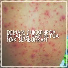 Demam, sakit kepala, sakit punggung, dan merasa lelah. Suami Demam Chicken Pox Petanda Dan Petua Nak Sembuh Husniey Husain