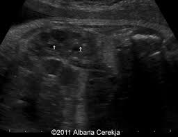 Username Password Signup Forgot Password Search Dictionary For Genetic Test For Books List Of Omm Medline Nih Online Mendelian Inheritance In Man Anatomy Emedicine Thefetus Net Thefetus Home Articles Cases Tools Links About