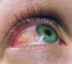 Image result for Allergic Conjunctivitis