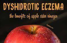 The Benefits Of Apple Cider Vinegar For Dyshidrotic Eczema Eczemaroutine Home Remedies For Eczema Apple Cider Benefits Eczema Diet