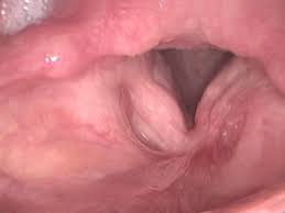 The sensation of a lump in the throat is called globus. Queensland Voice Centre Larynx And Throat Cancer