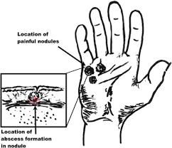 Image result for phlegmon of hand)