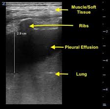 Image result for Thoracentesis