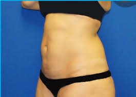 Mini tummy tuck before and after photos from real upstate ny patients if you're an active person looking to improve the look of your lower abdomen, a mini tummy tuck might be the ideal cosmetic surgery for you. Patient 3634 Mini Tummy Tuck Before And After Photos La Jolla Plastic Surgery Gallery Coronado Dr Daniel Brown