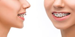 Can Braces Fix an Overbite? - Rallis & Bonilla Orthodontics