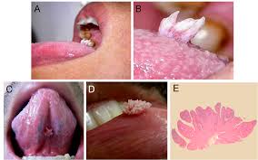 Image result for papillomavirus tongue)