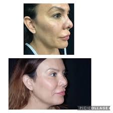 Neck/Chin Liposuction Albuquerque NM, D. Eric Tuggle, D.D.S.