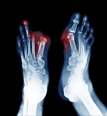 Image result for toe amputation