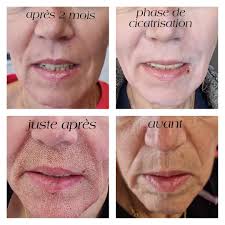 EMBELLISSEMENT CORPOREL: cicatrices, alopécie, calvitie,vitiligo