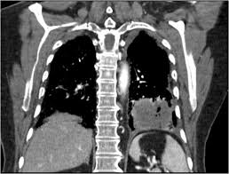 Image result for Lung Abscess