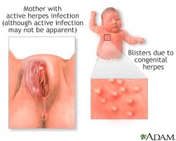 Image result for genital herpes