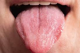 Image result for cancer of tongue